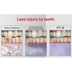 Woodpecker Parodontal ultralydsrenser PT5. Smertefri parodontal behandling