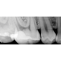 Woodpecker i-Sensor. Digital Rntgensensor. Leveres i str. 1 og 2.
