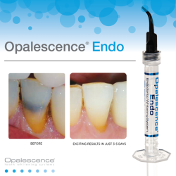 Opalescence Endo Refill Kit  Tandblegning til Dde Tnder (2 x 1,2ml). Effektiv tandblegning.