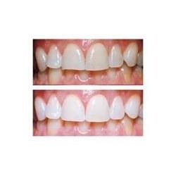 Opalescence PF. 4 x 1,2ml. Tandblegemiddel. 16% karbamidperoxid m/ kaliumnitrat, fluor og mintsmag