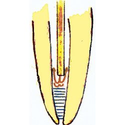 VMK Endoneedle. Fleksible endokanyler 28Gx1" (0,35 mm x 25 mm)